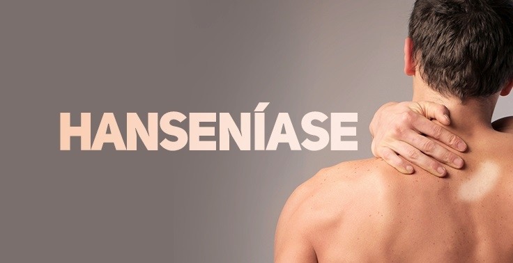 Lucas do Rio verde participará de inquérito nacional sobre hanseníase