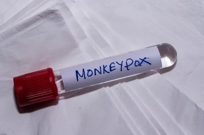 Primeiro caso suspeito de Varíola Monkeypox é descartado em Lucas do Rio Verde