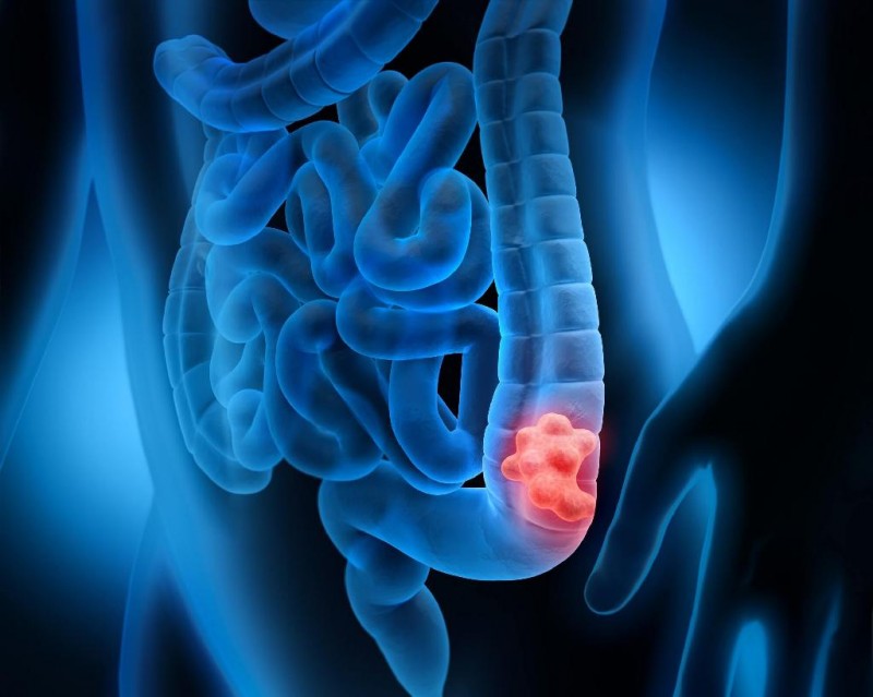 Câncer de intestino está entre os mais comuns para homens e mulheres