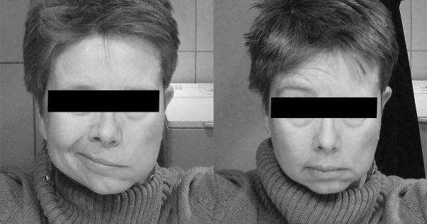 Parlamentar solicita uso de toxina botulínica em pacientes com paralisia facial