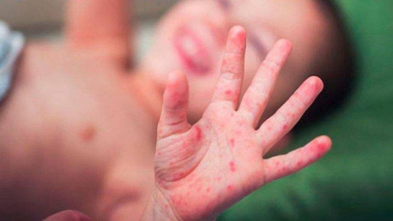 Vigilância em Saúde alerta sobre cuidados para prevenção contra a síndrome mão-pé-boca em Lucas do Rio Verde